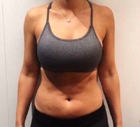 Előtte - HIEMT izomépítés