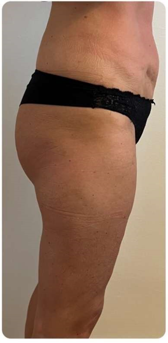 Előtte - Hi-sculpt Pro Gép eredménye