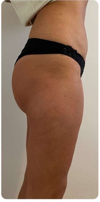 Utána - Hi-sculpt Pro Gép eredménye