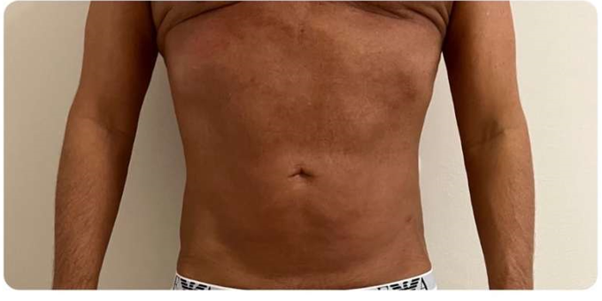 Utána - Hi-sculpt Pro Gép eredménye