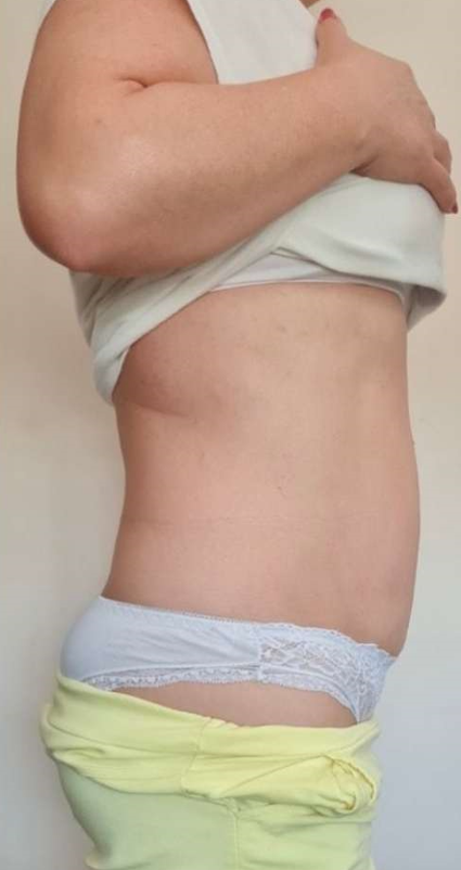 Utána - Hi-sculpt Pro Gép eredménye